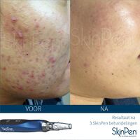 SkinPen