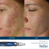 SkinPen